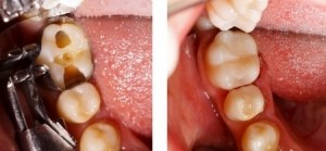 What are Composite Fillings? West Nyack Dentists Explains